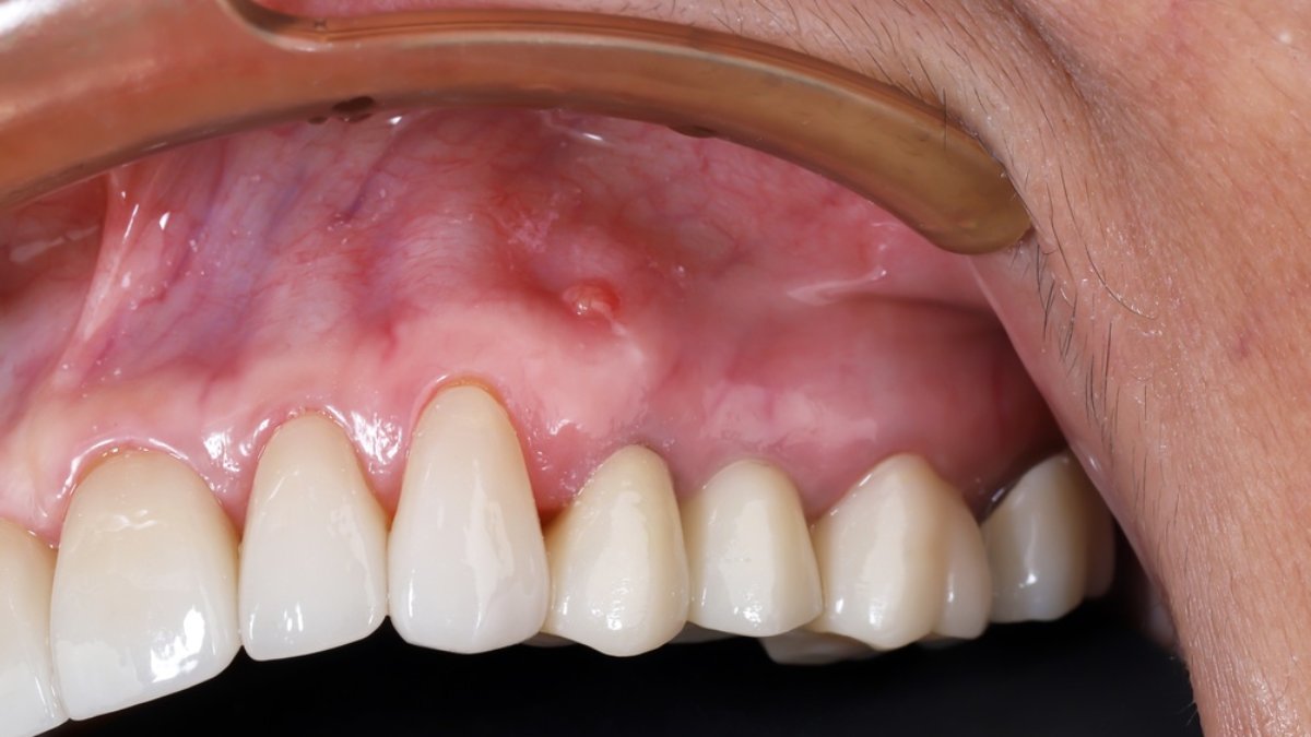 abces gingival