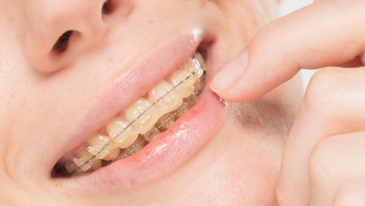 O persoană care poartă un aparat dentar din safir