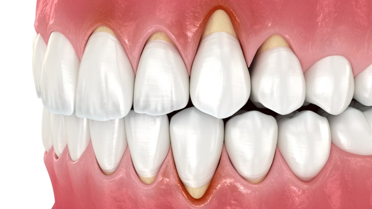 ilustratie retractie gingivala
