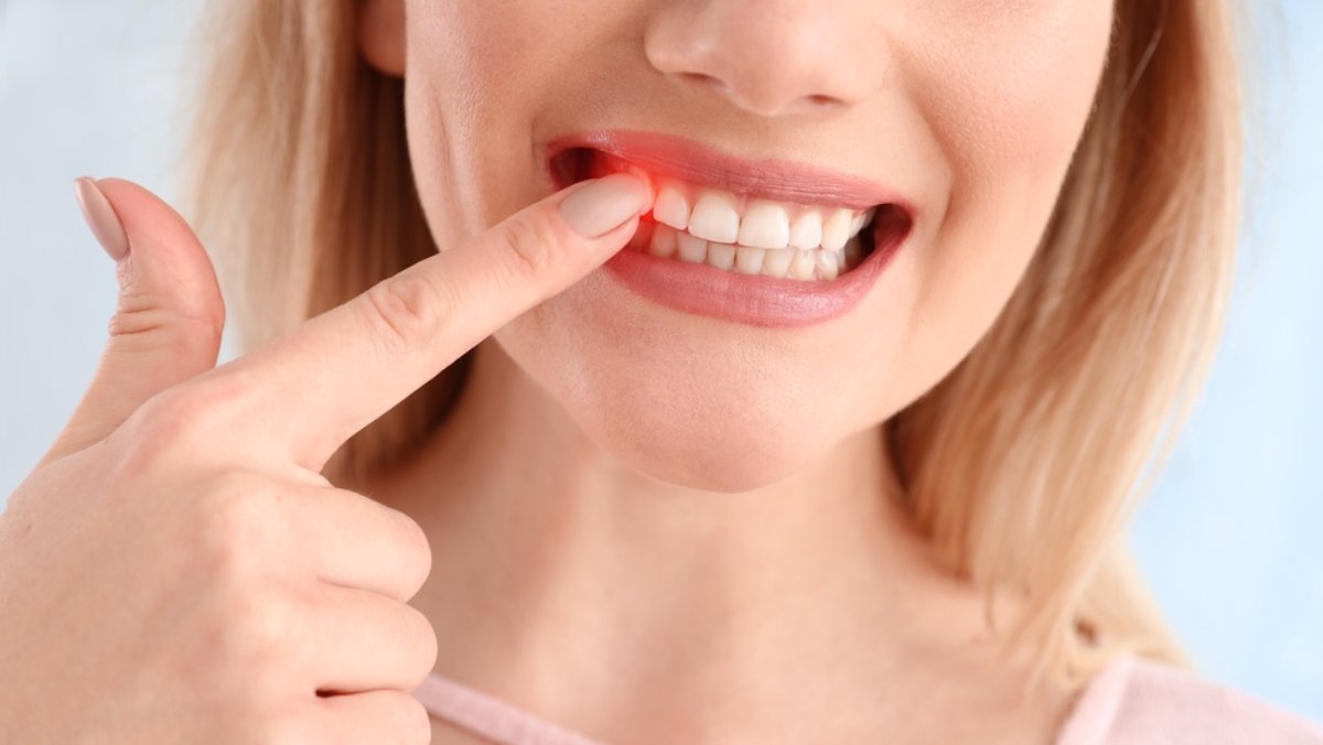 concept sângerare gingivală