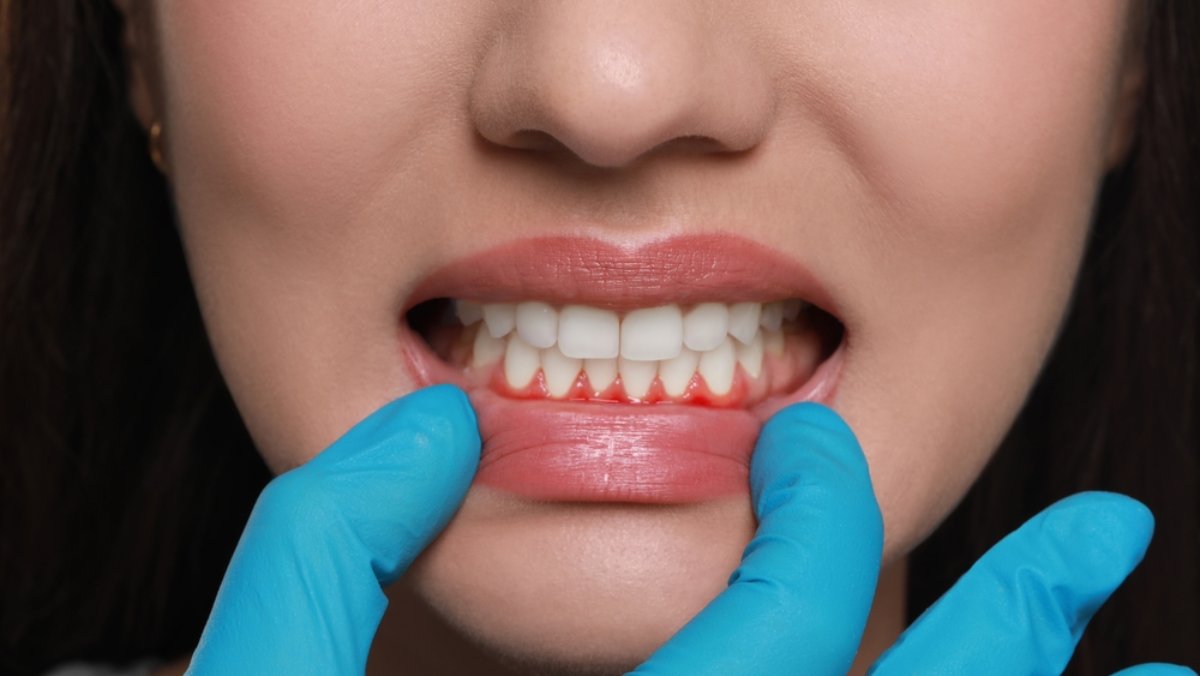 o persoană care suferă de gingivită