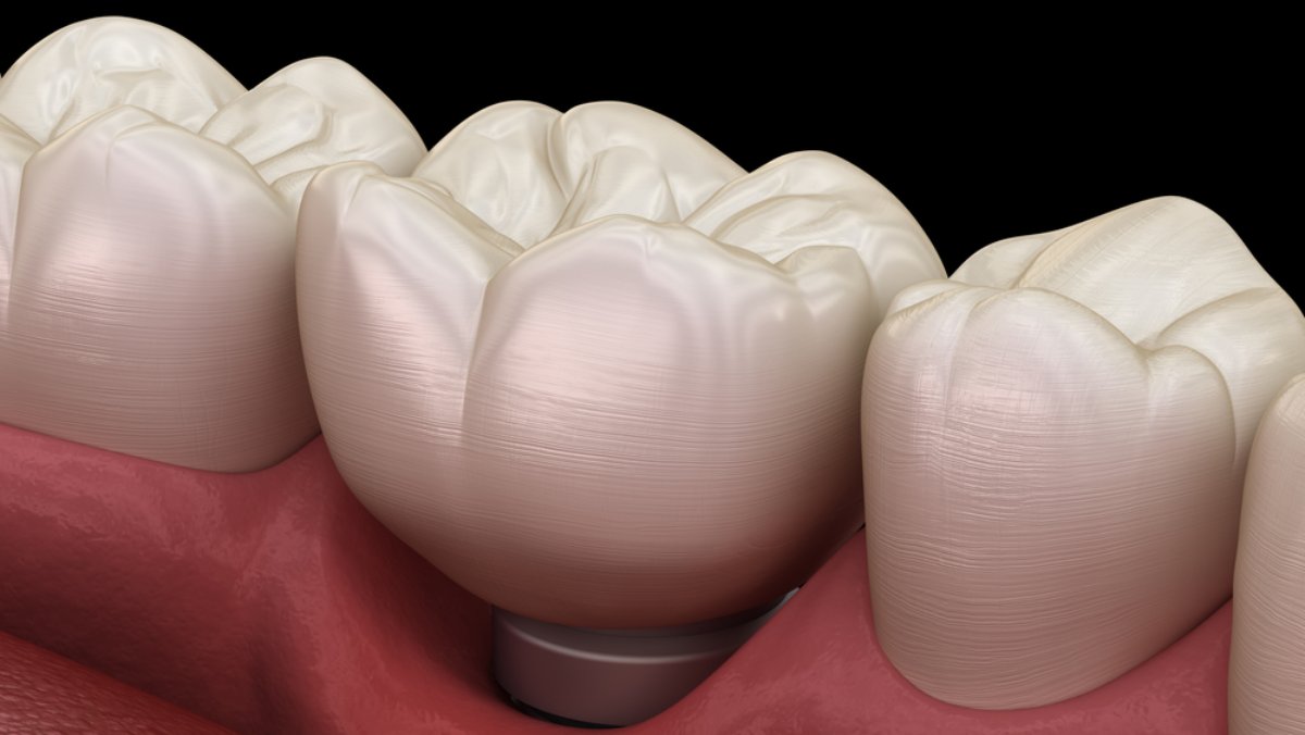 Periimplantită