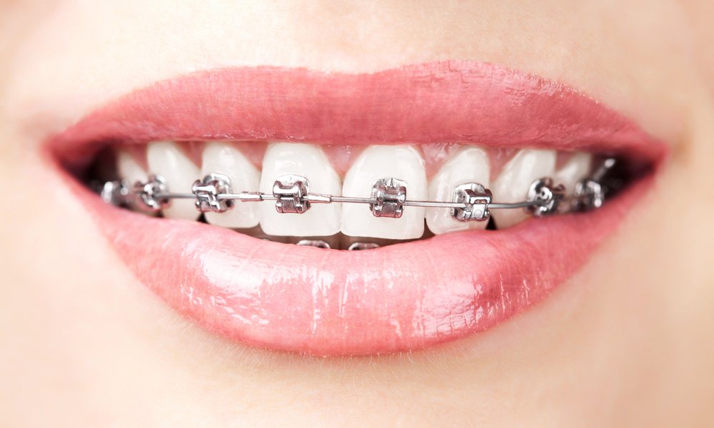 Aparat dentar metalic