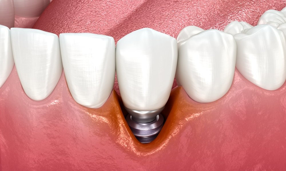 Retracție gingivală în jurul unui implant dentar