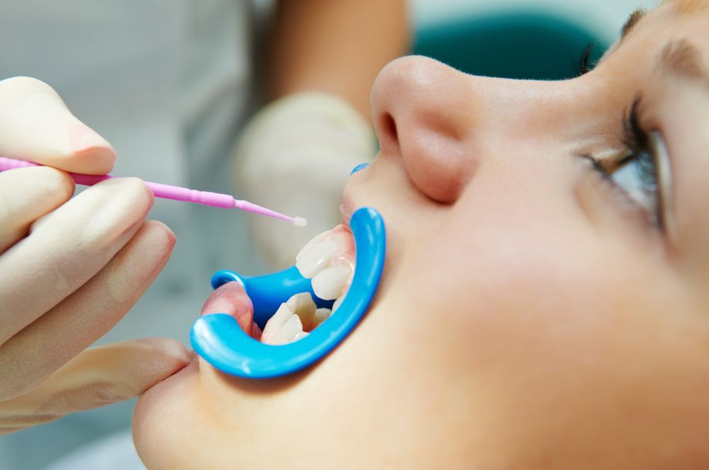 Fluorizarea dentară