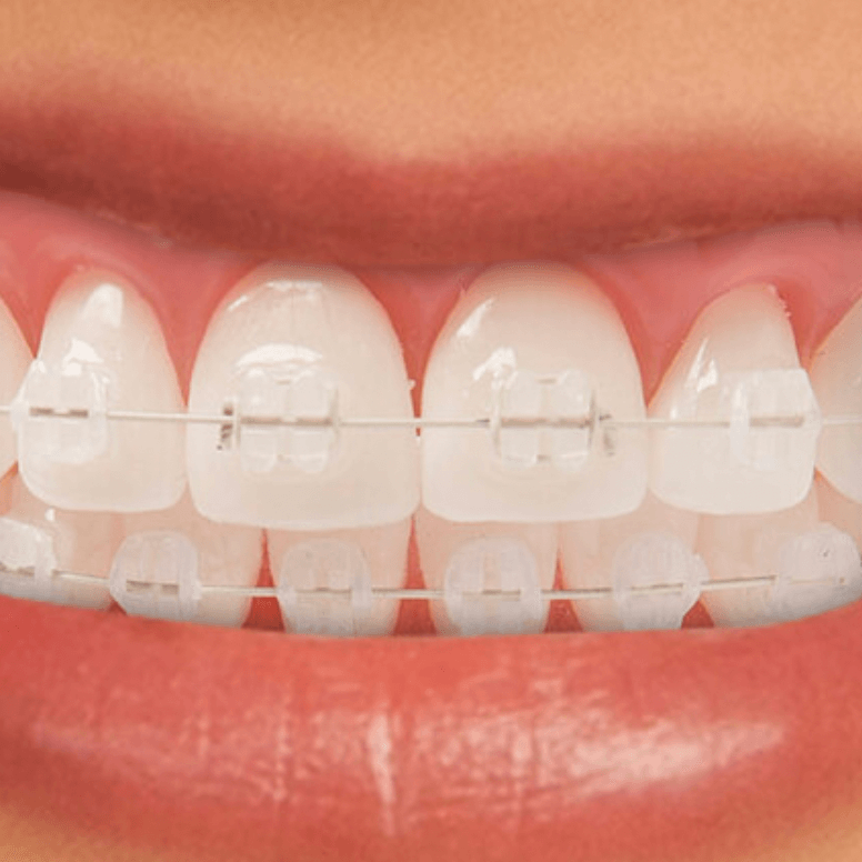 Aparate Dentare Ceramic