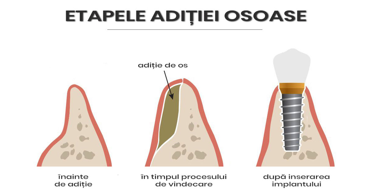 Aditie de Os + Regenerare Ghidata