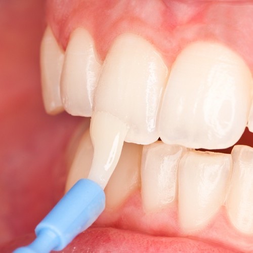 Fluorizarea dentara