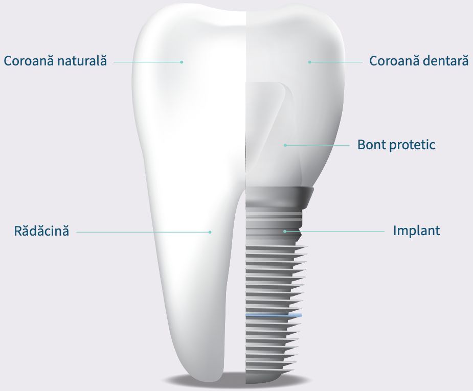 Dental Implant Ploiesti