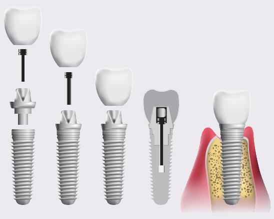 Implant Dentar
