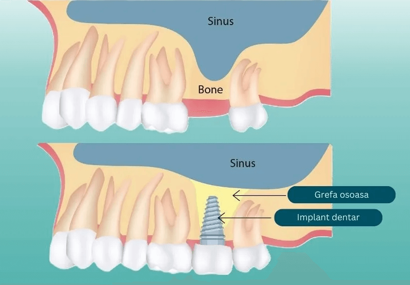 Sinus lift